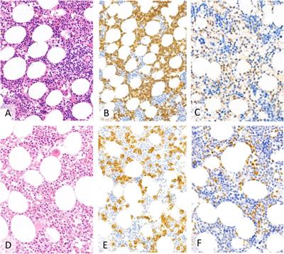 Long term follow-up of refractory/relapsed hairy cell leukaemia patients treated with low-dose vemurafenib between 2013 and 2022 at the Department of Internal Medicine and Oncology, Semmelweis University